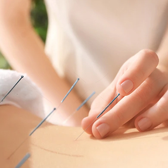 Acupuncture Treatment in Surrey